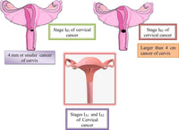 FRD Test for the diagnosis of cervical cancer (applicator + solution) x 1 piece UK